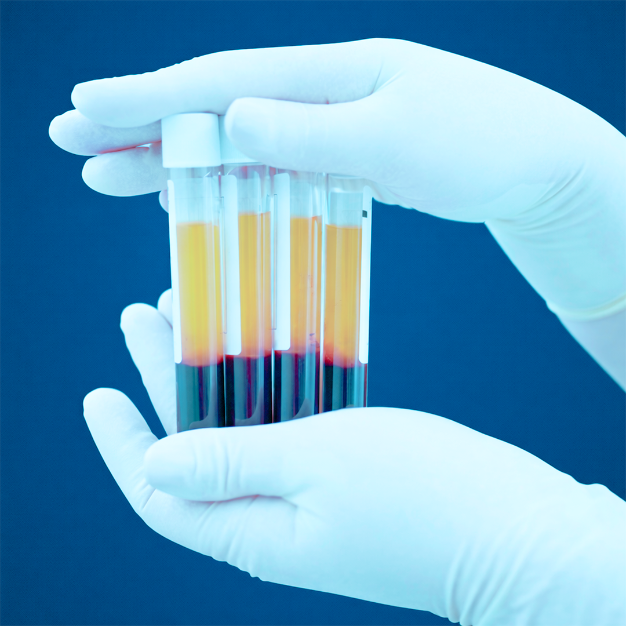 PLASMA RICO EN PLAQUETAS